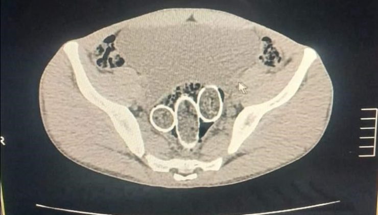 320 gram uyuşturucuyu mide ve rahme sakladılar